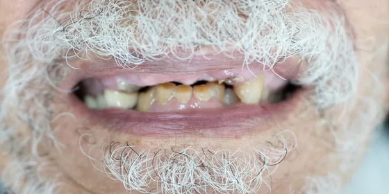 Antes: la sonrisa de un paciente mayor
