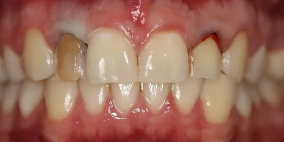 Antes: los dientes frontales