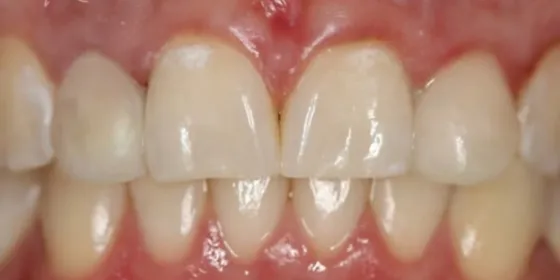 Después: los dientes frontales