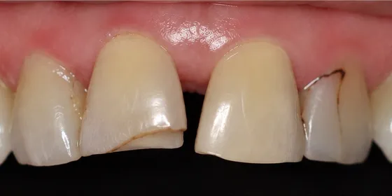 Antes: cuatro dientes frontales