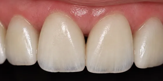 Después: cuatro dientes frontales