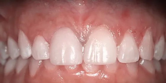 Después: los dientes frontales