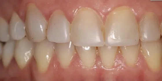 Antes: el color de los dientes
