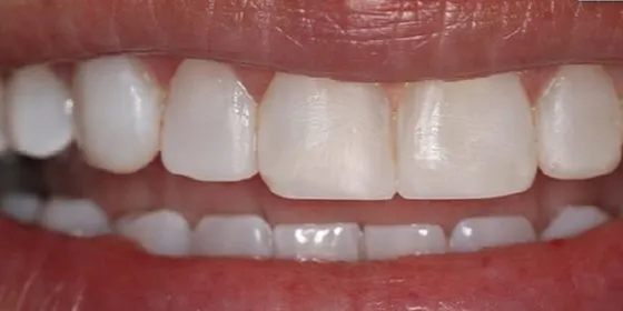 Después: el color de los dientes