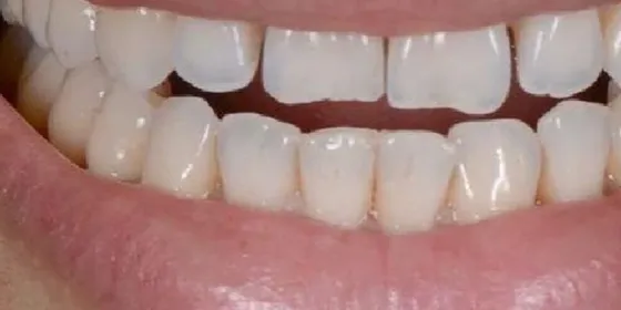 Antes: la sonrisa