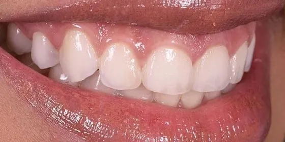 Antes: la sonrisa y la encía